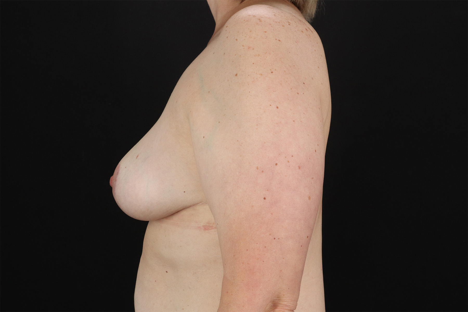 Breast Lift Before & After Patient #3004