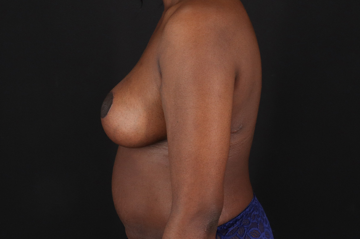 Breast Reduction with Lift Before & After Patient #3472