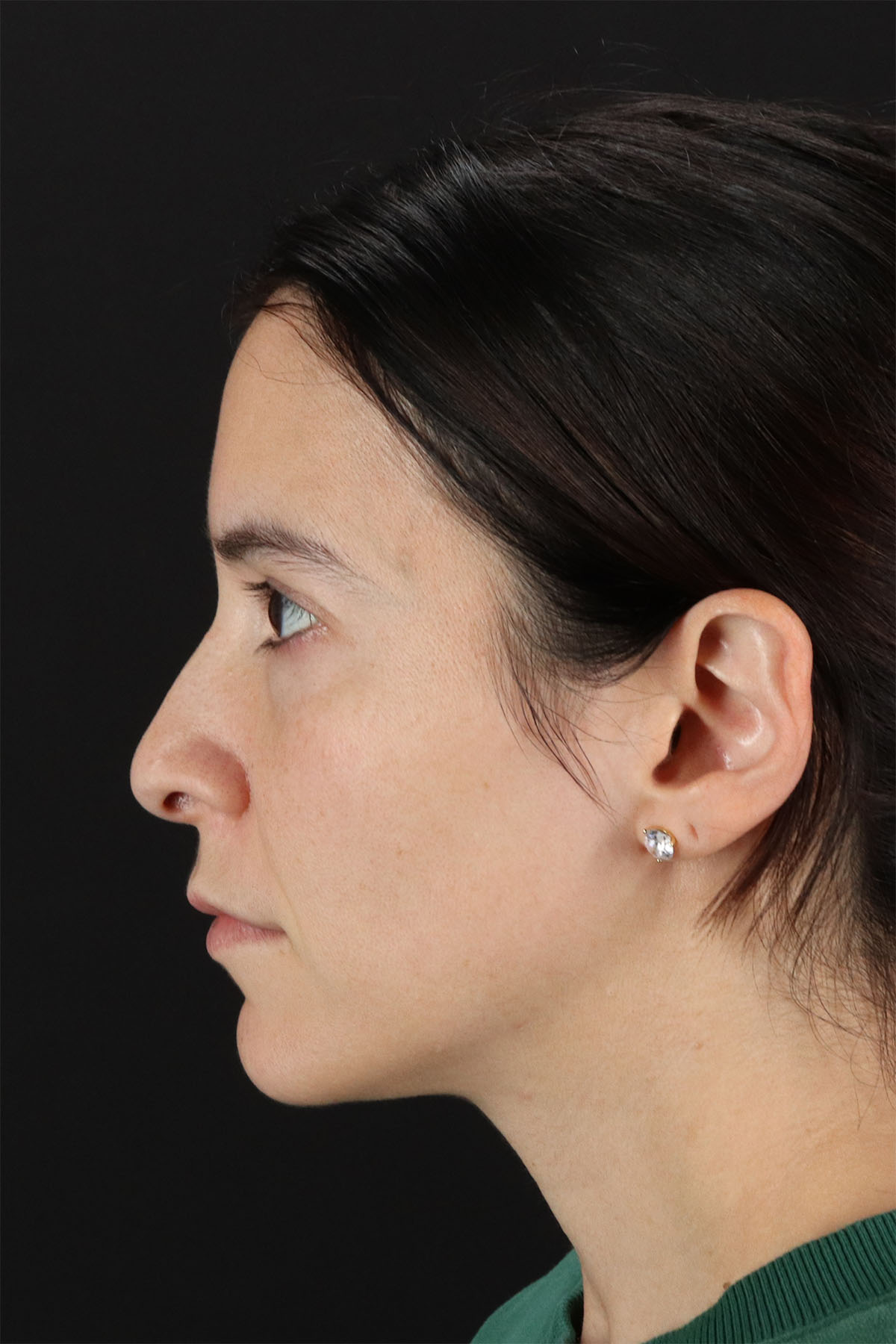 CO2 Laser Before & After Patient #3005