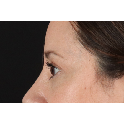 Eyelid Surgery Before & After Patient #3006