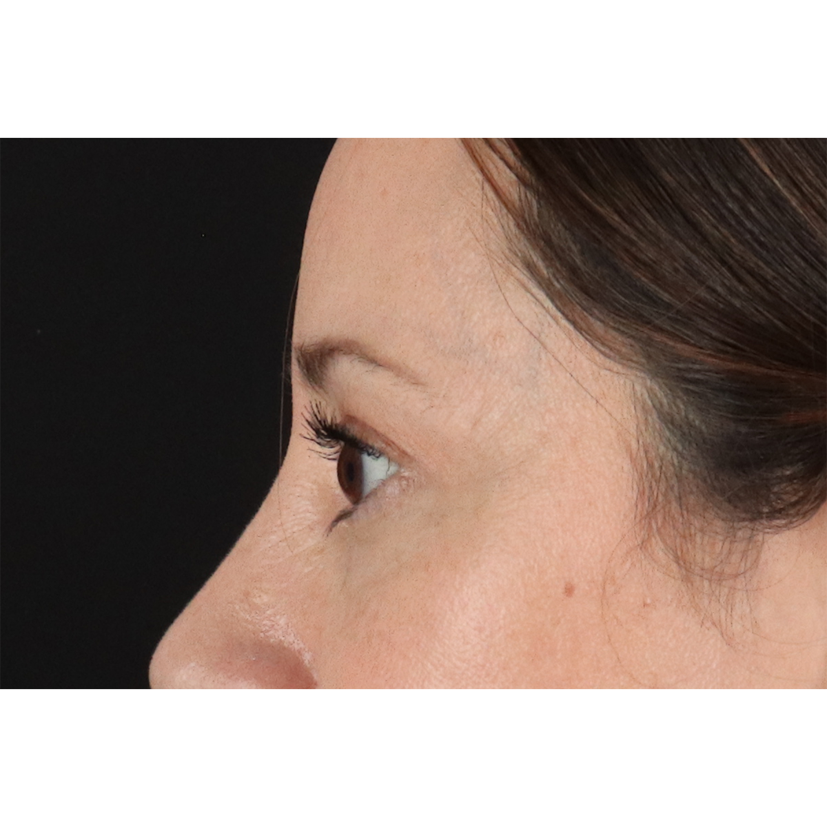 Eyelid Surgery Before & After Patient #3006