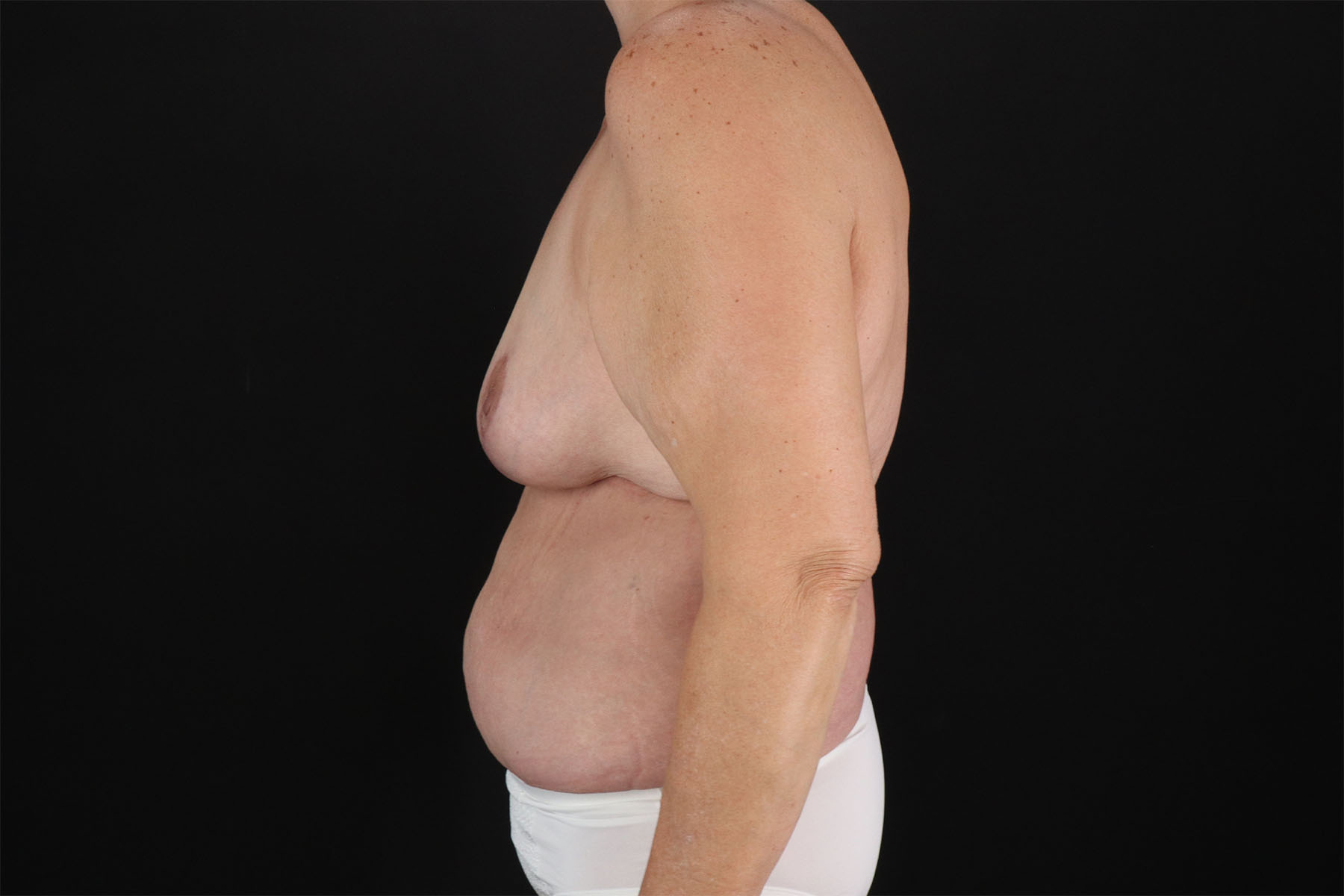 Breast Reduction with Lift Before & After Patient #3007