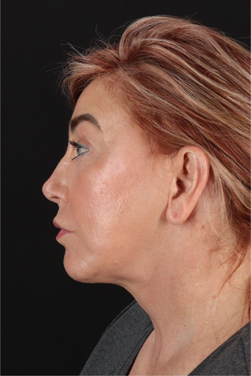 Neck Lift Before & After Patient #3476