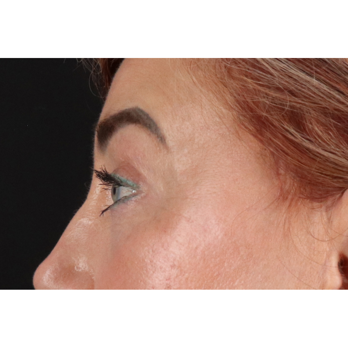 Eyelid Surgery Before & After Patient #3475