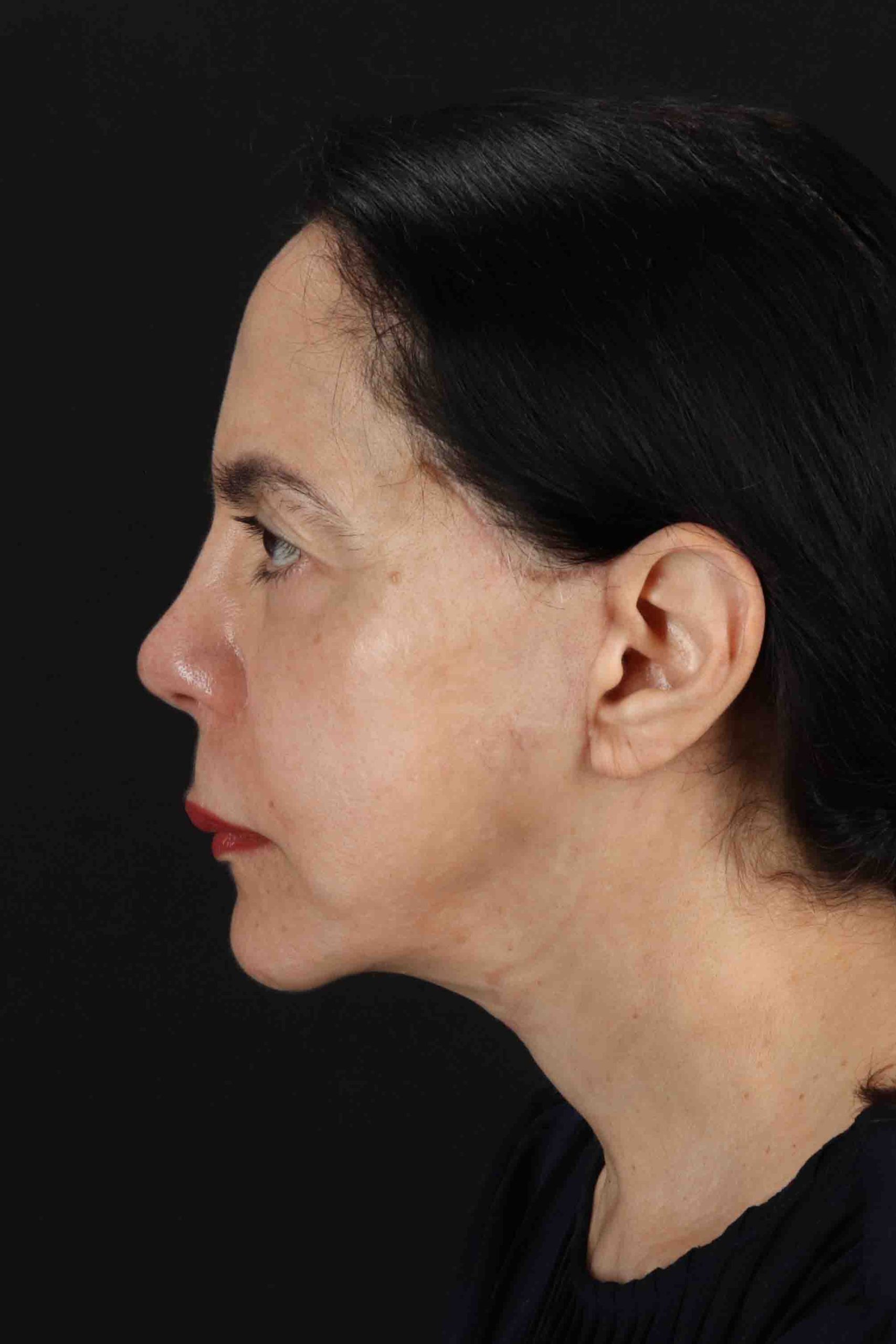 Structural Fat Grafting Before & After Patient #3645