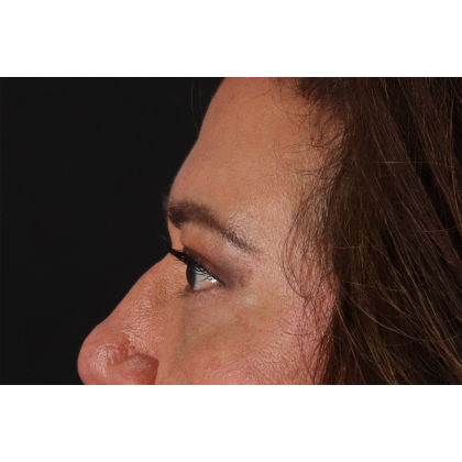 Eyelid Surgery Before & After Patient #3008