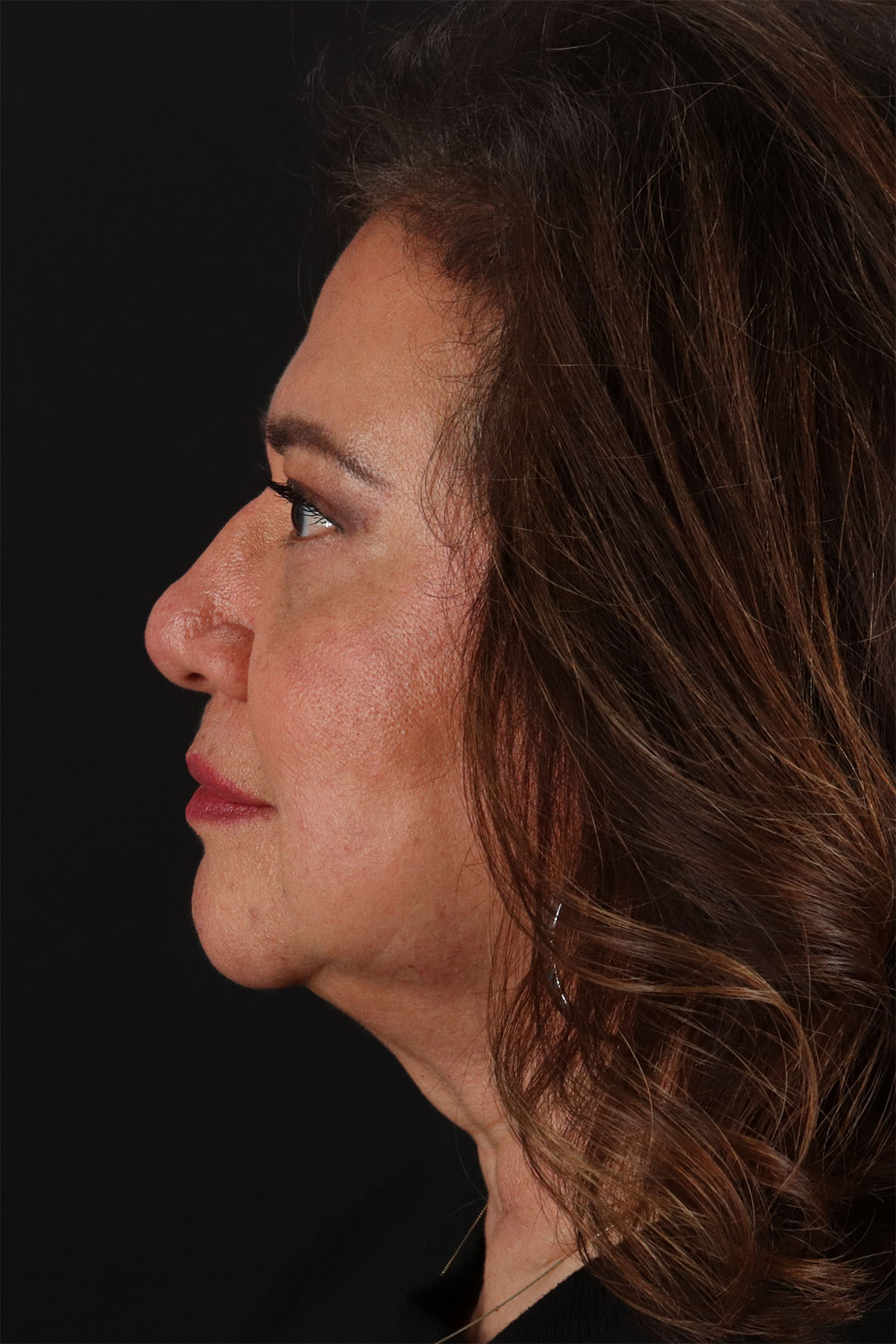 CO2 Laser Before & After Patient #3009