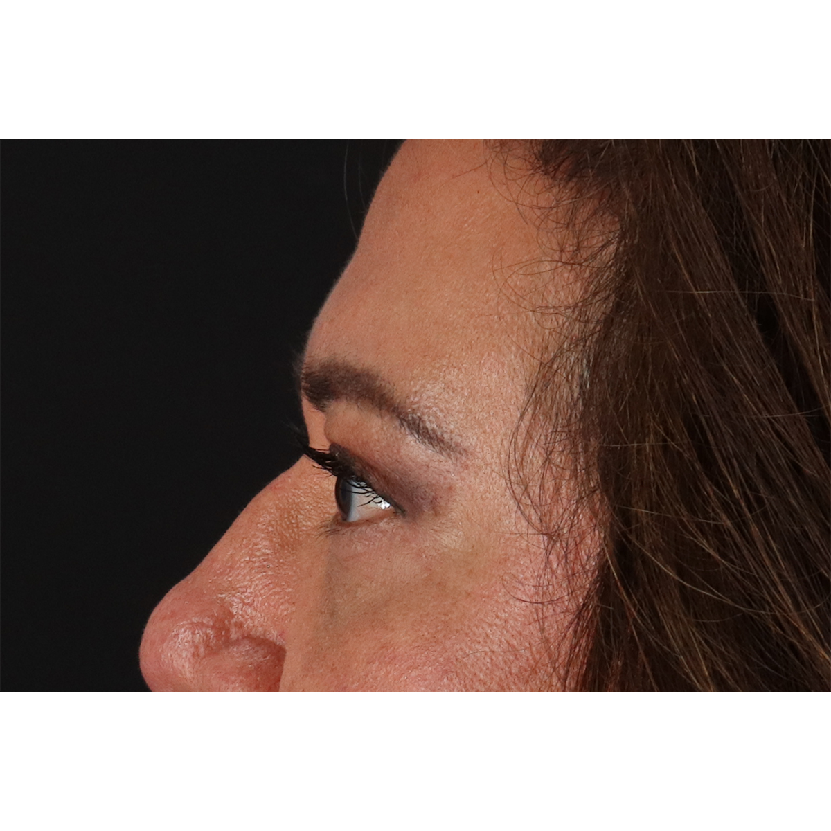 Eyelid Surgery Before & After Patient #3008