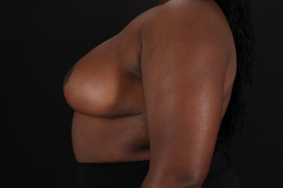 Breast Reduction with Lift Before & After Patient #3478