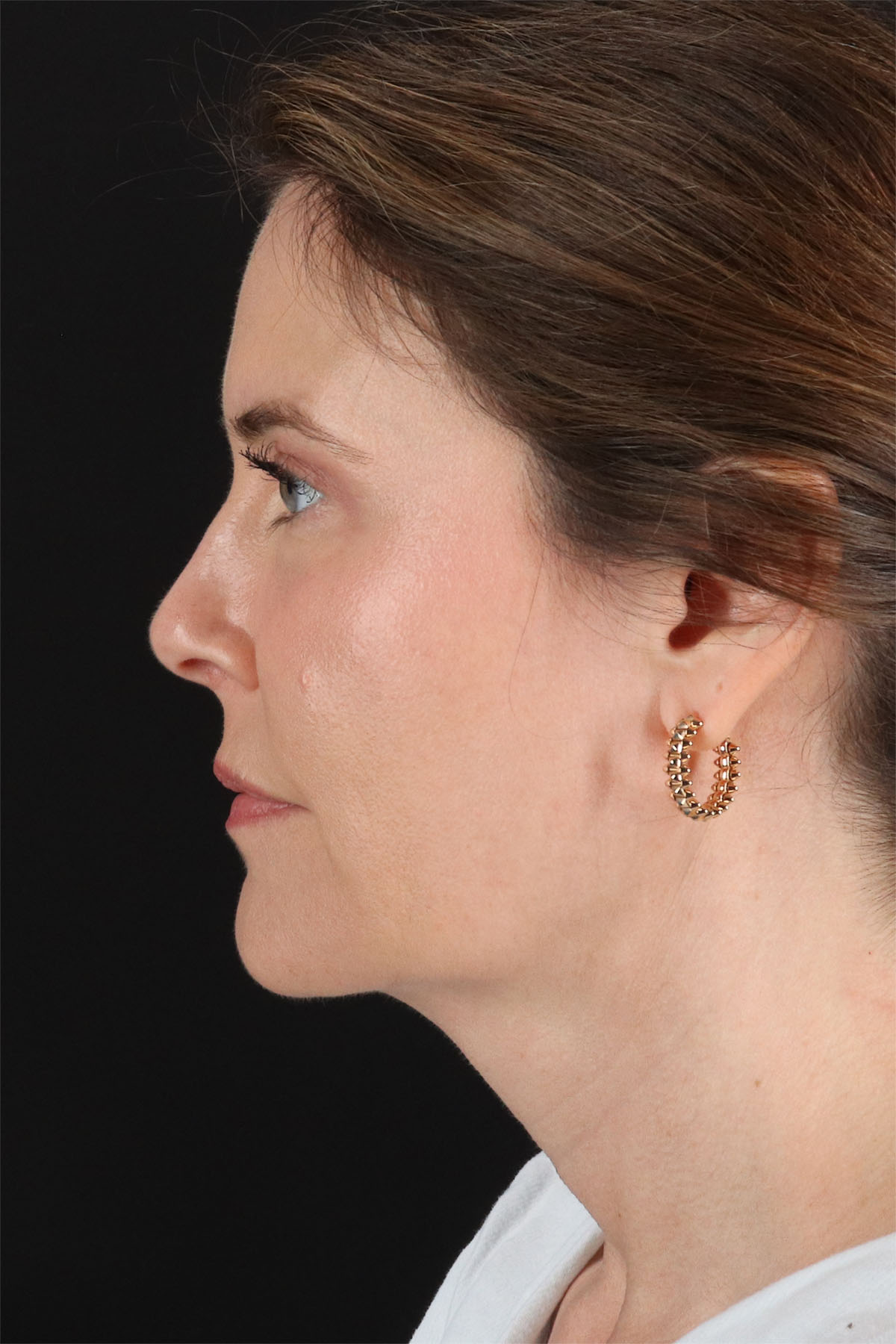 Structural Fat Grafting Before & After Patient #3647