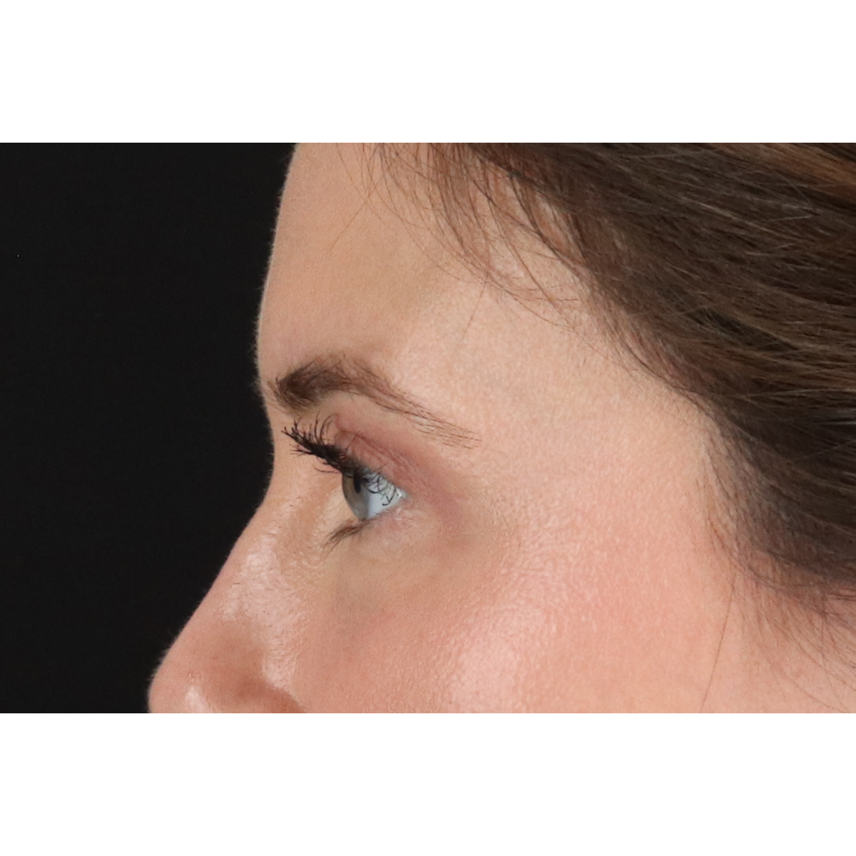 Eyelid Surgery Before & After Patient #3570
