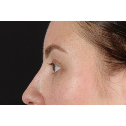 Brow Lift Before & After Patient #3111