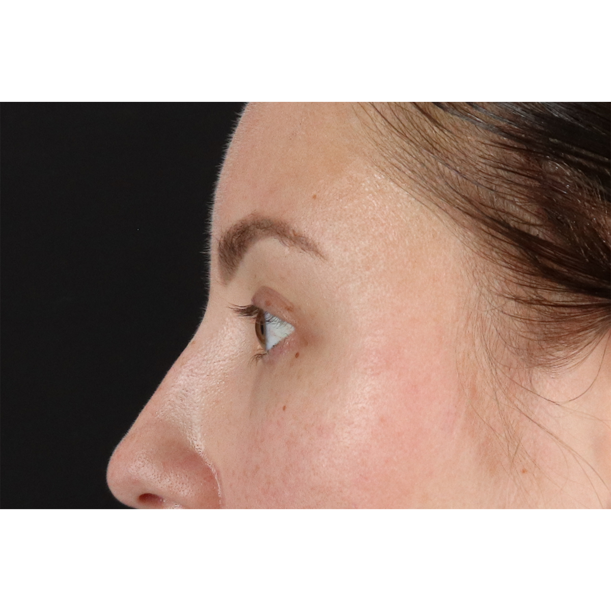 Brow Lift Before & After Patient #3111