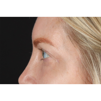 Eyelid Surgery Before & After Patient #3112