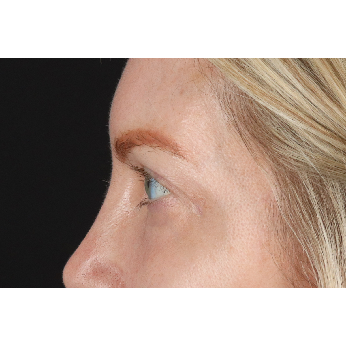 Eyelid Surgery Before & After Patient #3112