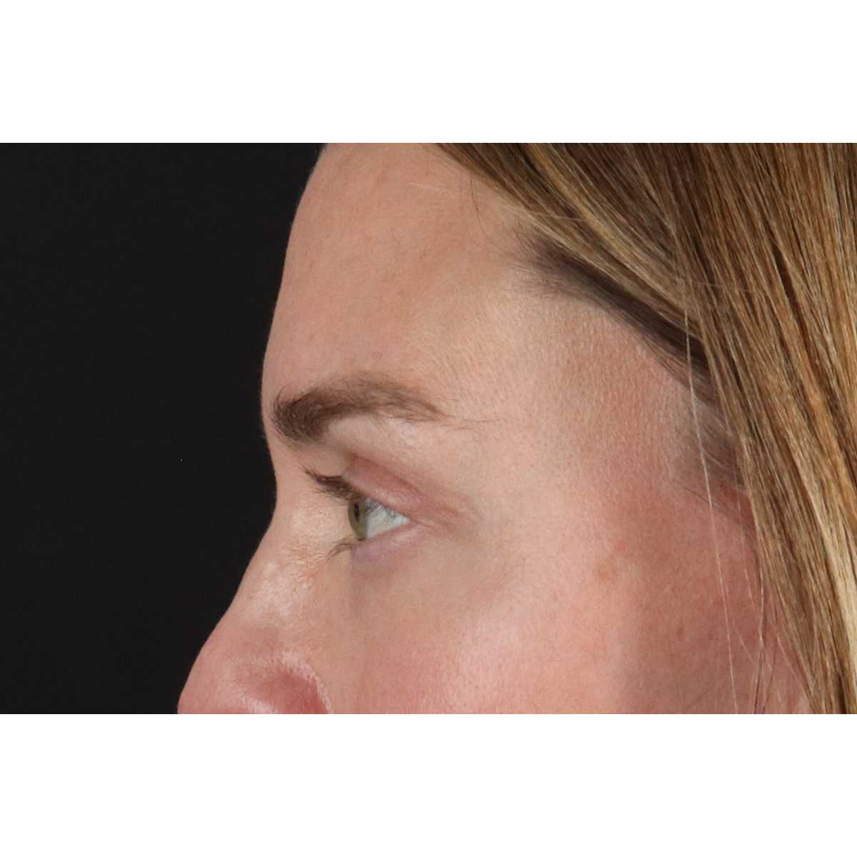 Eyelid Surgery Before & After Patient #3571