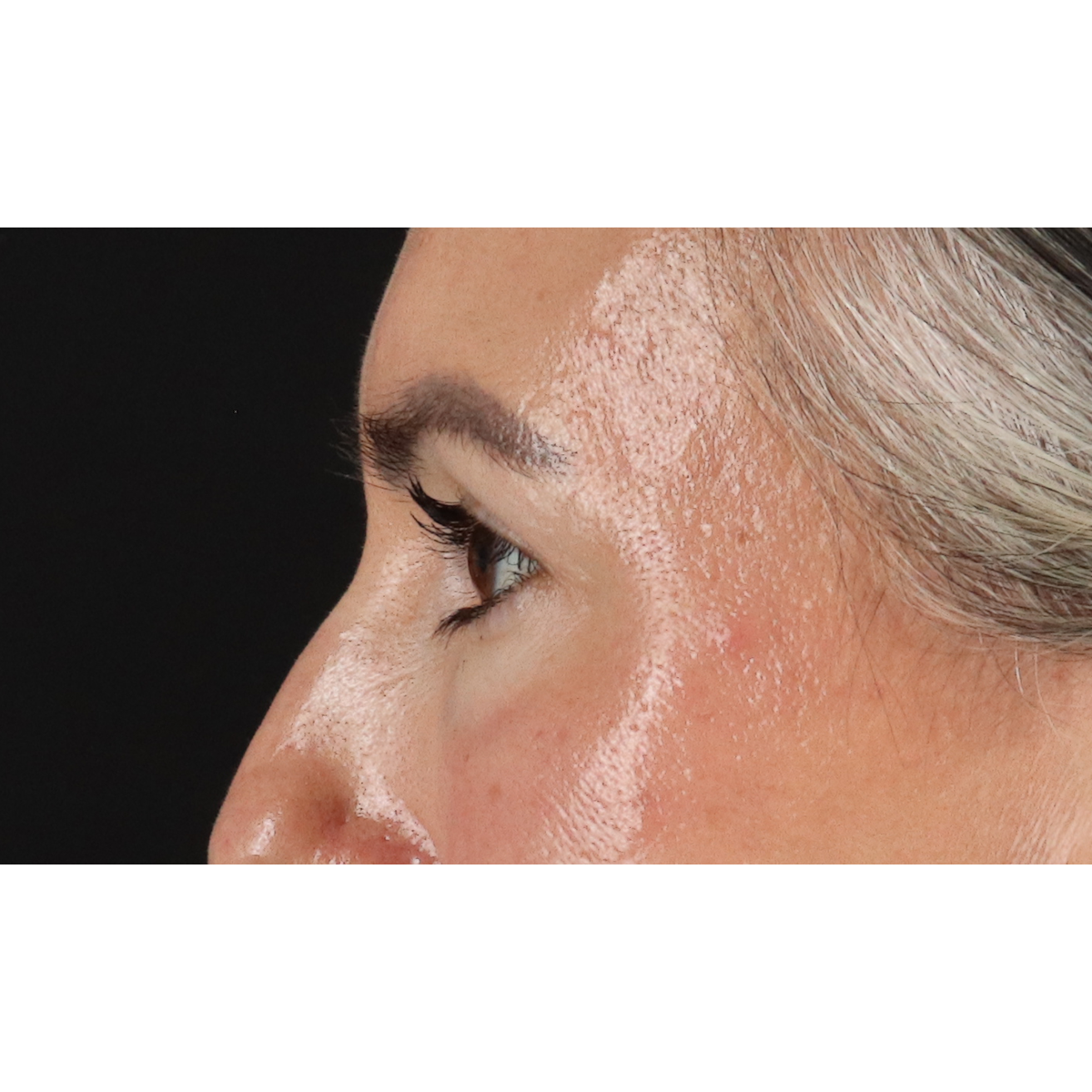 Eyelid Surgery Before & After Patient #3356