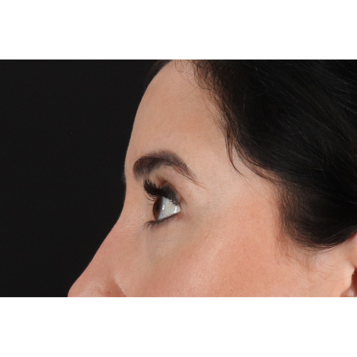 Eyelid Surgery Before & After Patient #3358