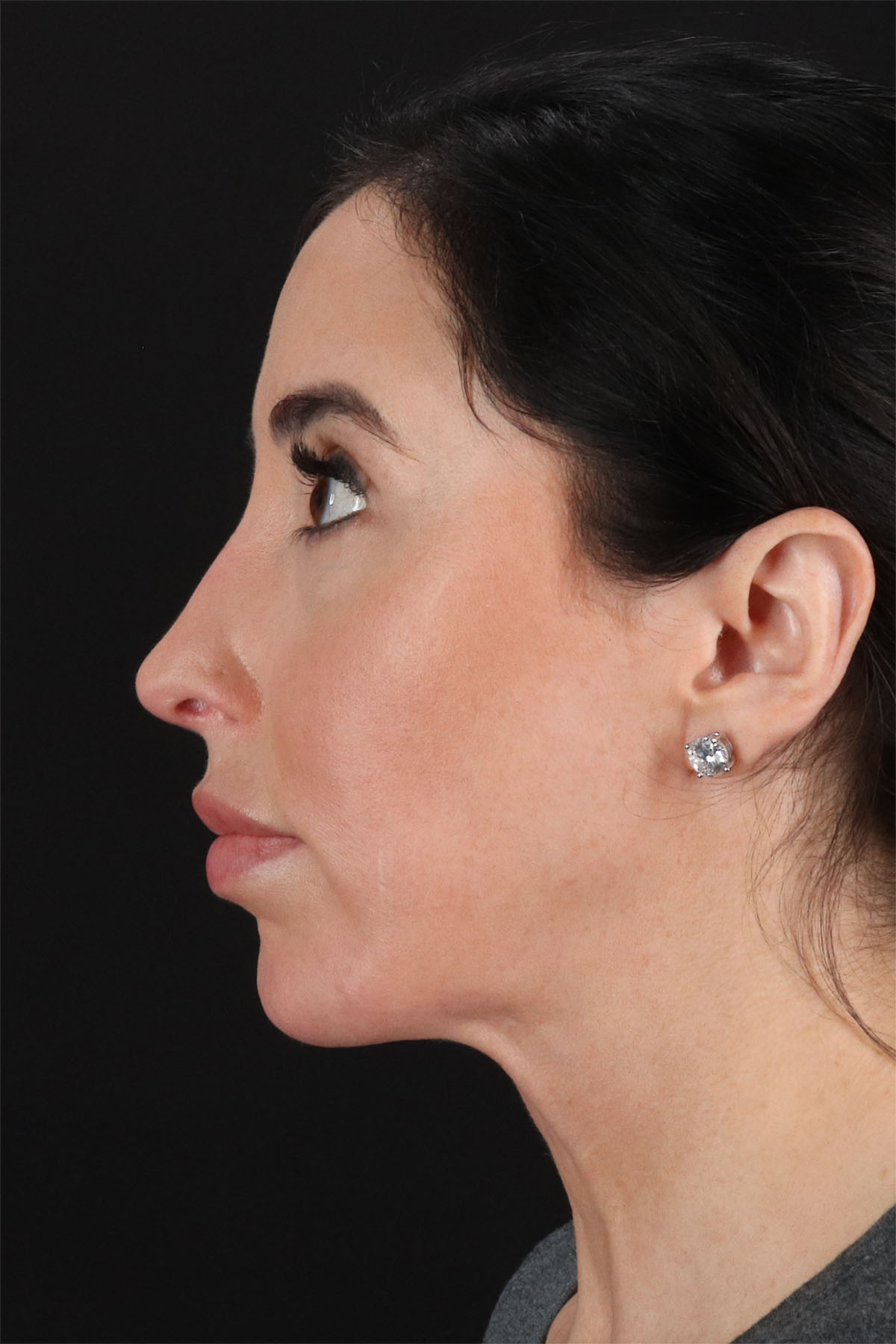 Structural Fat Grafting Before & After Patient #3649