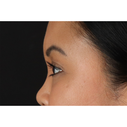 Brow Lift Before & After Patient #3114