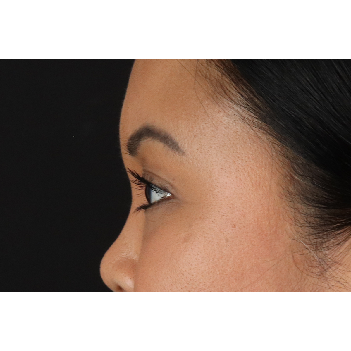 Brow Lift Before & After Patient #3114
