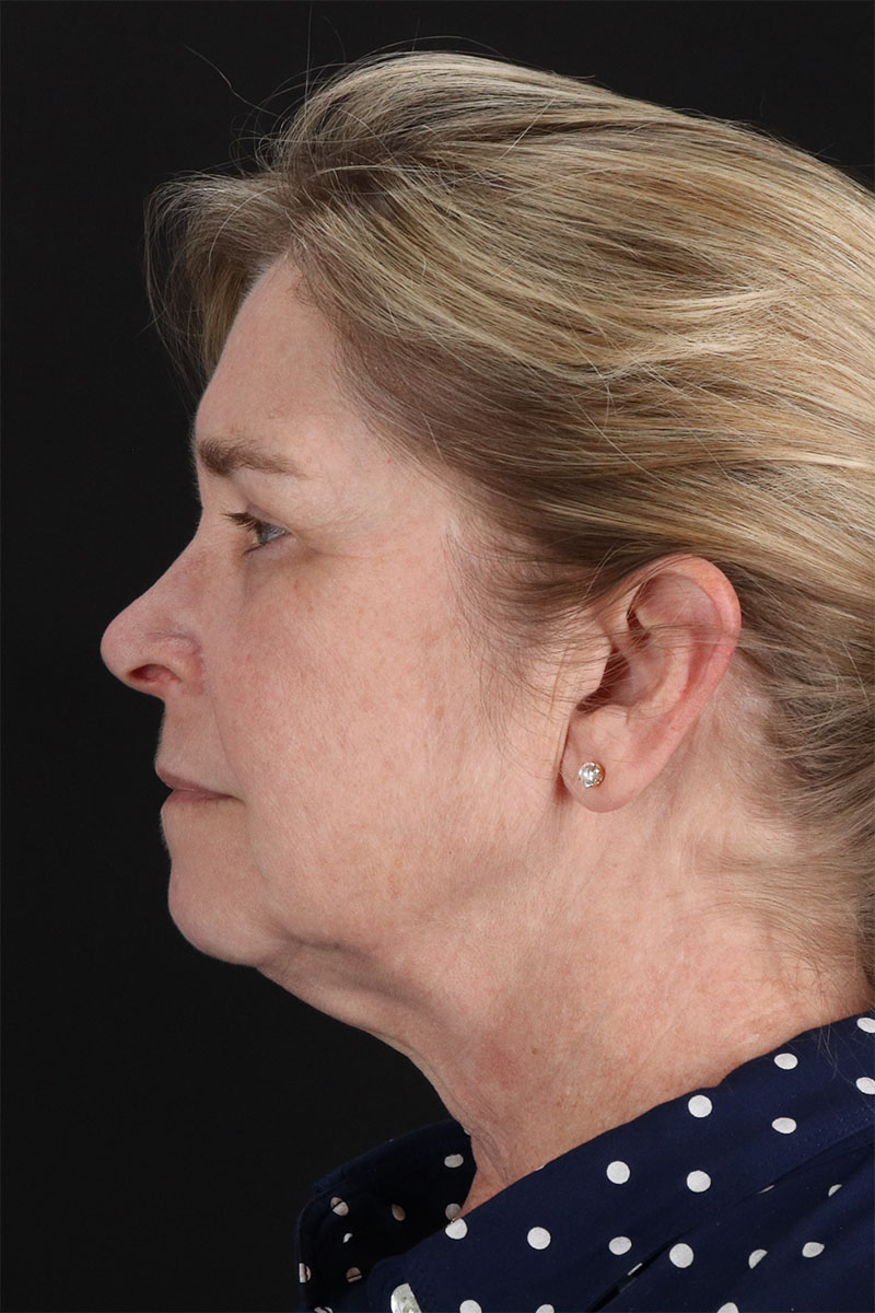 CO2 Laser Before & After Patient #3116