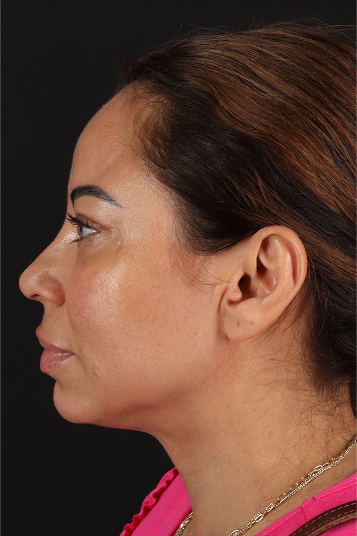 Laser Before & After Patient #3359