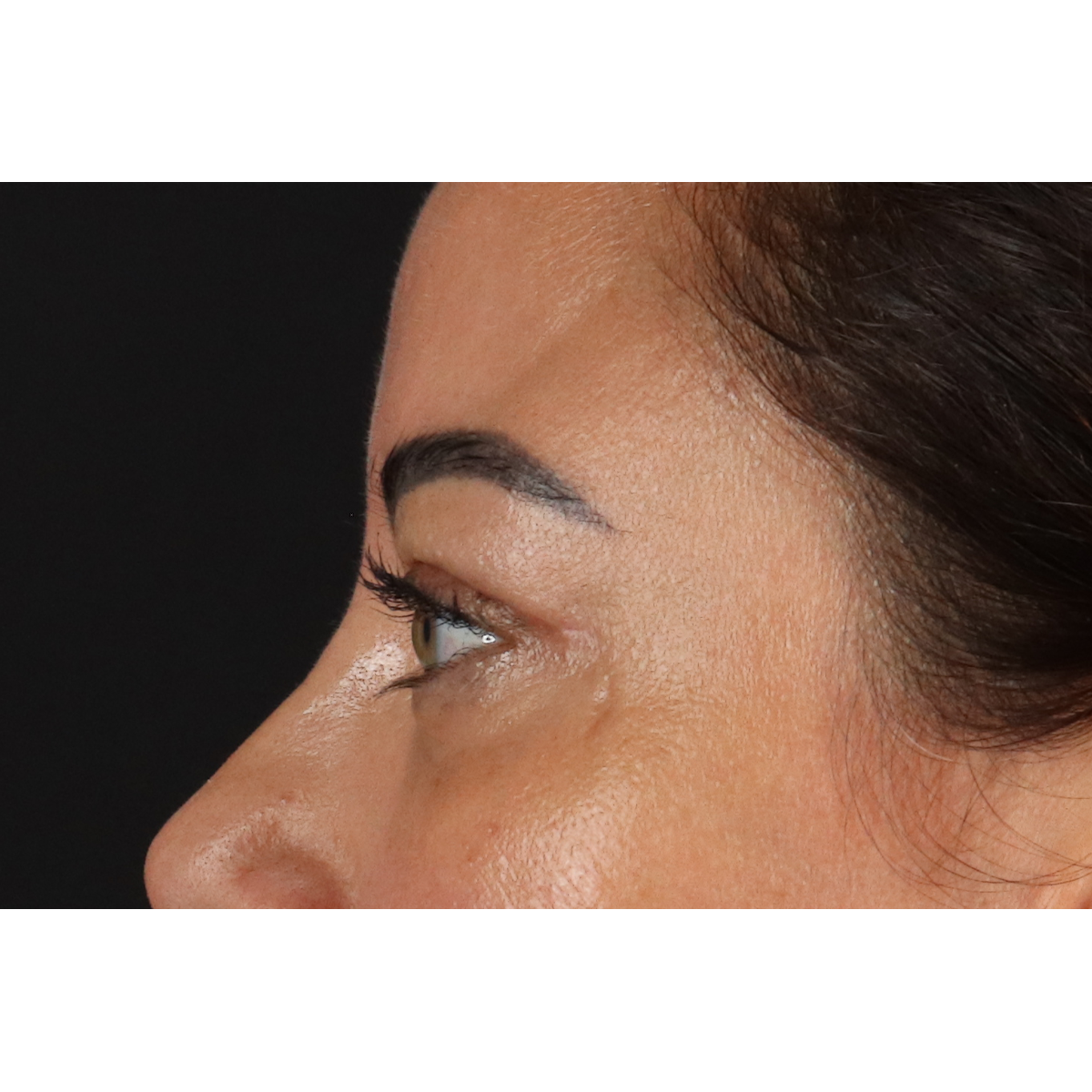 Eyelid Surgery Before & After Patient #3360