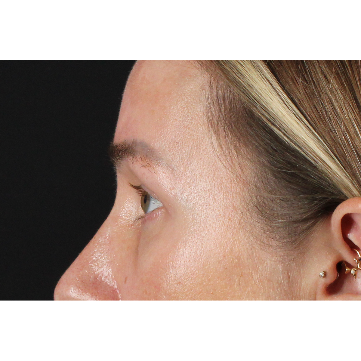 Eyelid Surgery Before & After Patient #3361