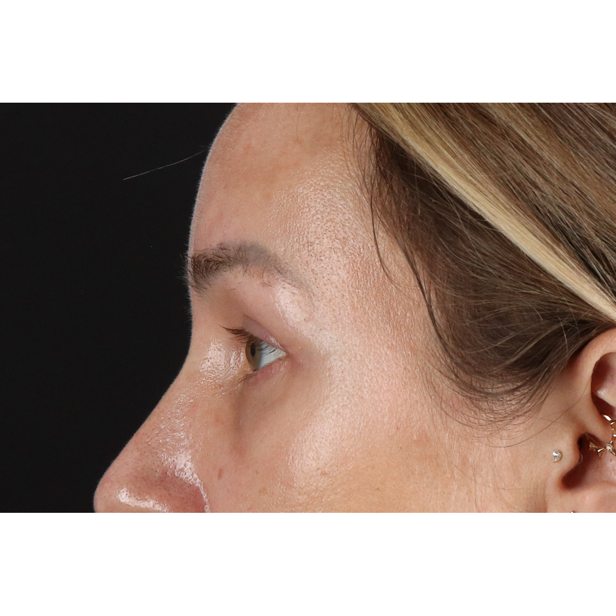 Eyelid Surgery Before & After Patient #3361
