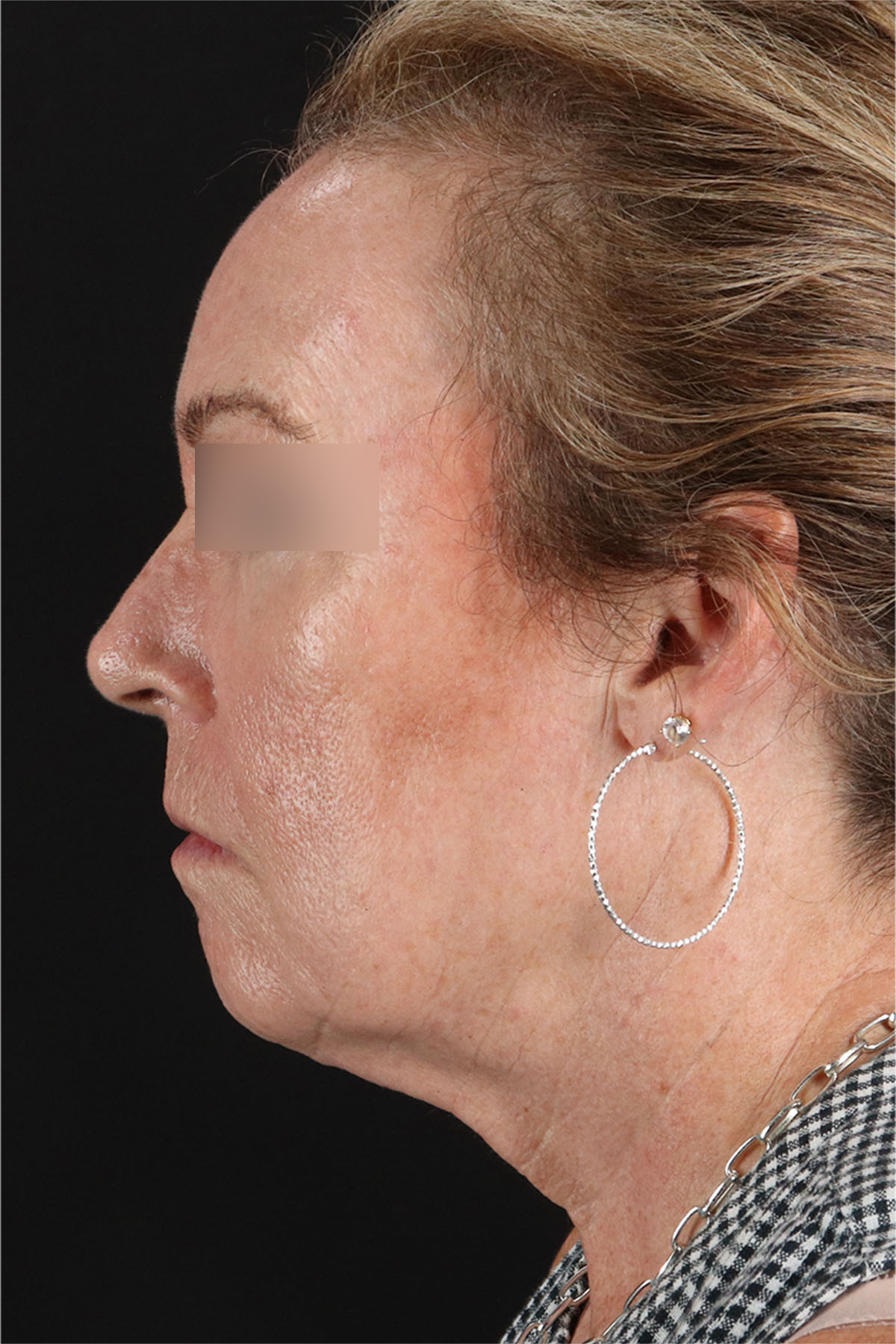 Laser Before & After Patient #3362