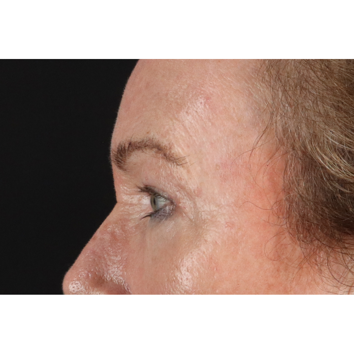 Eyelid Surgery Before & After Patient #3363