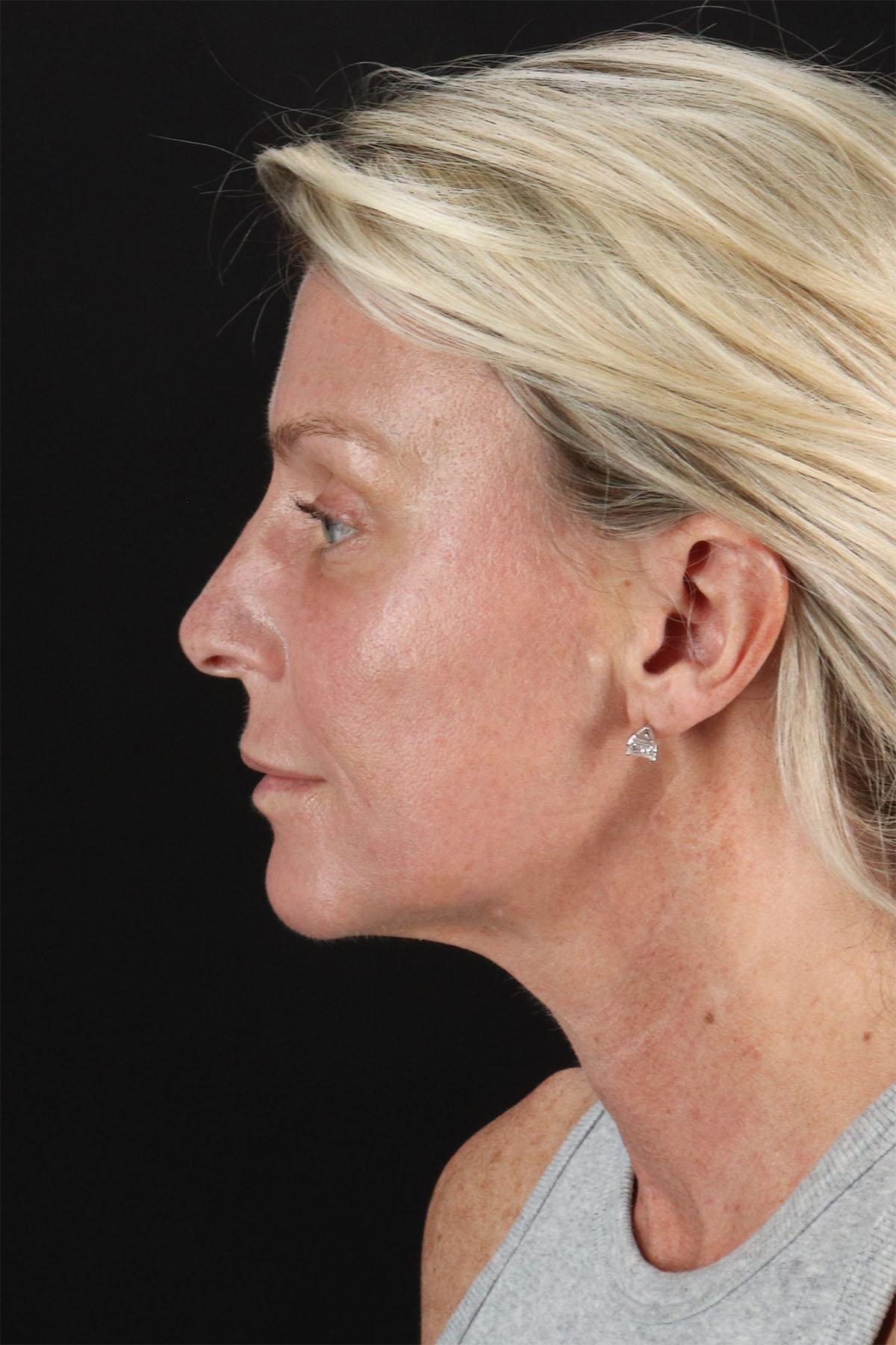 Ponytail Facelift Before & After Patient #3118