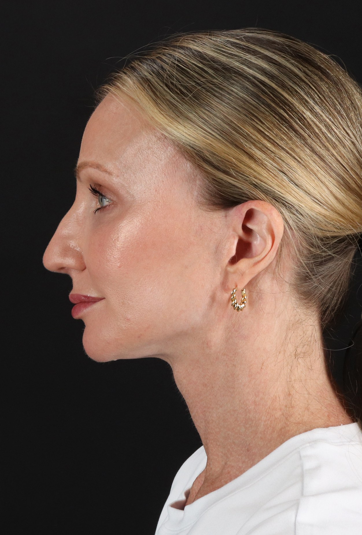 Face Lift Before & After Patient #3219