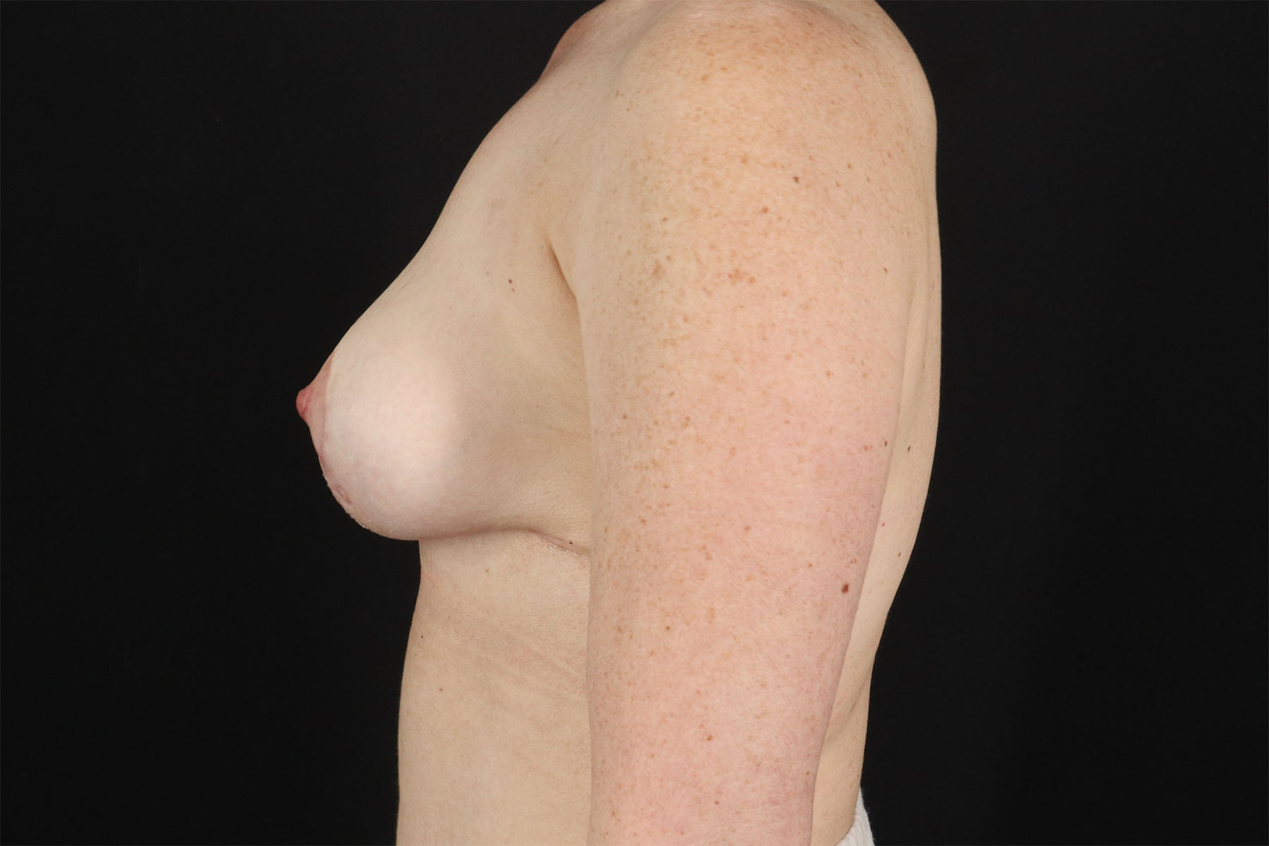 Breast Lift Before & After Patient #3115