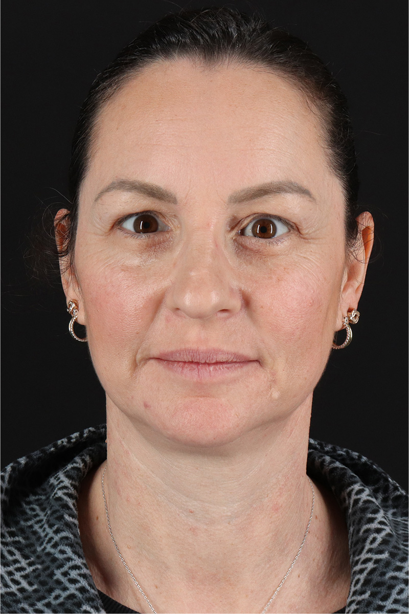 Chemical Peel Before & After Patient #3470