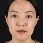 Skin Resurfacing / Laser Before & After Patient #3001