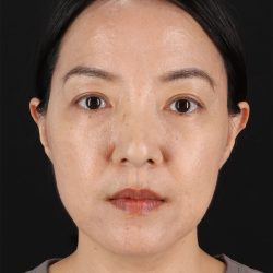 Skin Resurfacing / Laser Before & After Patient #3001