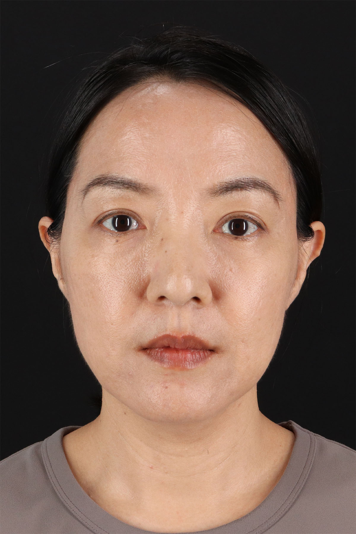 Skin Resurfacing / Laser Before & After Patient #3001