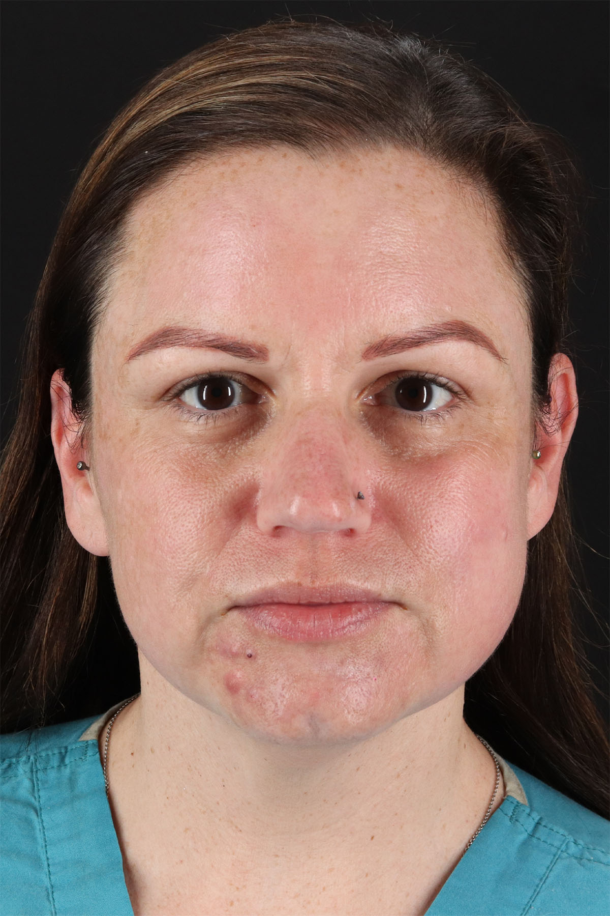 Chemical Peel Before & After Patient #3002