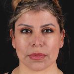 Structural Fat Grafting Before & After Patient #3642
