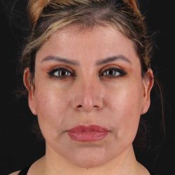 Structural Fat Grafting Before & After Patient #3642