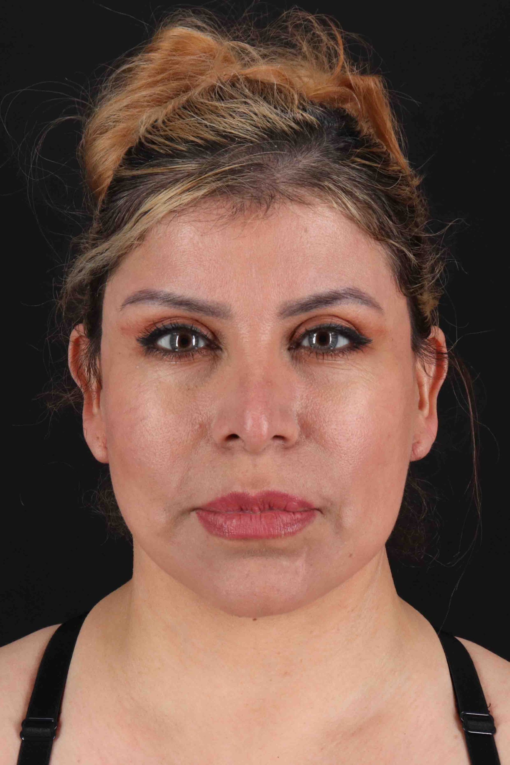 Structural Fat Grafting Before & After Patient #3642