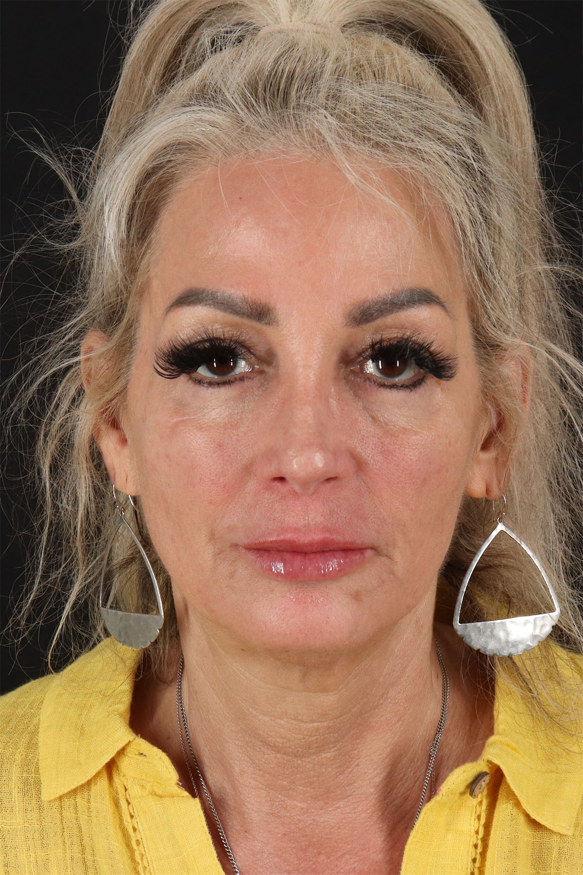 CO2 Laser Before & After Patient #3003