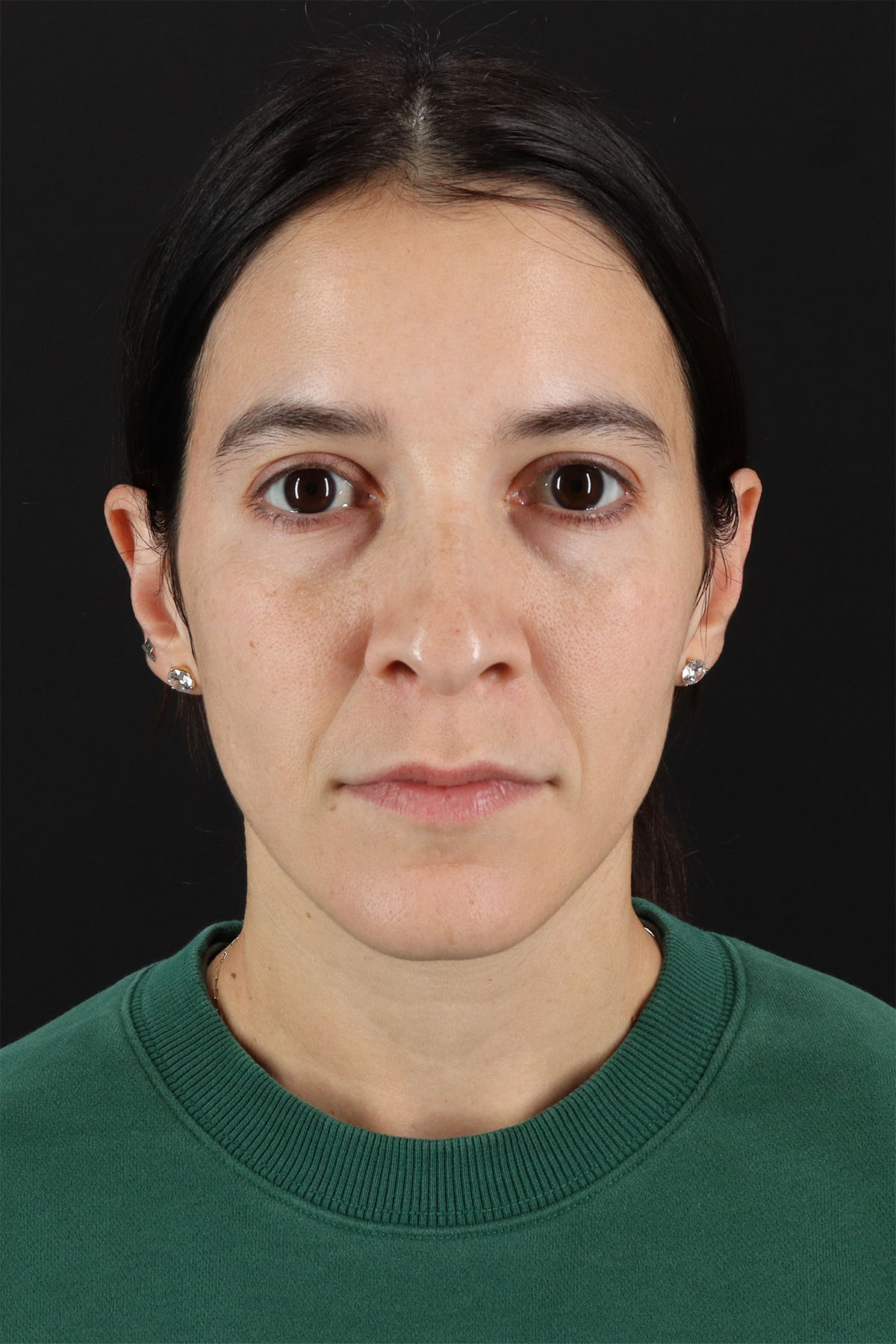 CO2 Laser Before & After Patient #3005