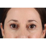 Eyelid Surgery Before & After Patient #3006