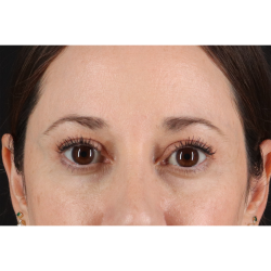 Eyelid Surgery Before & After Patient #3006