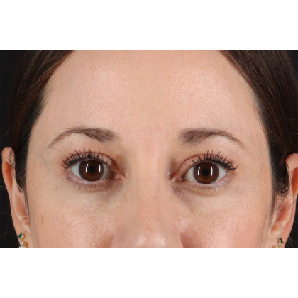 Eyelid Surgery Before & After Patient #3006