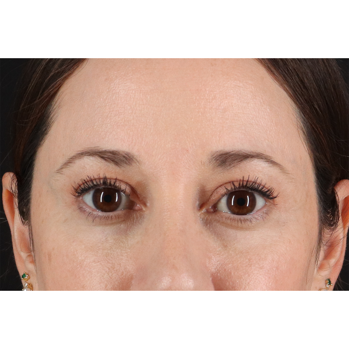 Eyelid Surgery Before & After Patient #3006