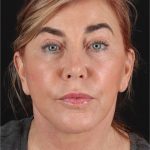 Neck Lift Before & After Patient #3476